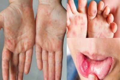 Biện pháp phòng và điều trị bệnh tay chân miệng tại nhà